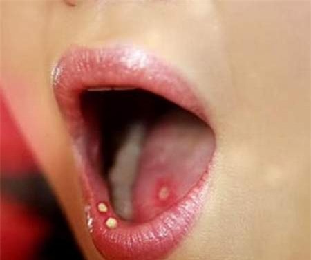 Viêm loét miệng có thể là dấu hiệu của nhiều bệnh. 