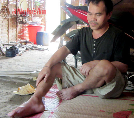 Sau 5 tháng chữa trị, vết thương của anh Trương Văn Nghiêm vẫn chưa lành.