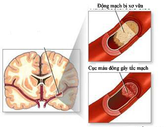 Động mạch nuôi não bị xơ vữa hoặc tắc là nguyên nhân gây tai biến  mạch não.