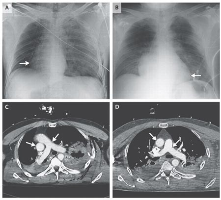 Ảnh chụp X-quang và chụp cắt lớp vi tính hé lộ, trái tim của bệnh nhân tự xoay 90 độ từ bên trái sang bên phải của lồng ngực. Ảnh: The New England Journal of Medicine