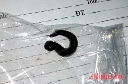 Đỉa được lấy ra từ thanh quản bệnh nhân