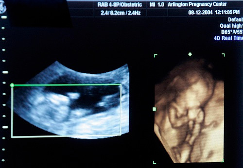 Hình ảnh siêu âm thai nhi. Ảnh: Reutes