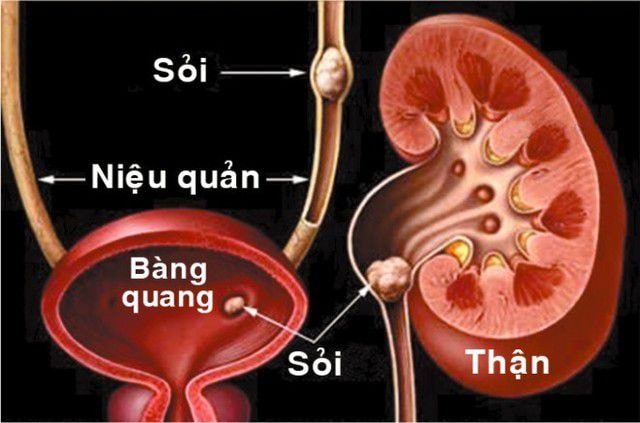 ​Bị sỏi thận do bổ sung quá nhiều vitamin C.