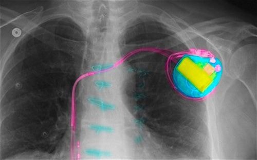 Máy trợ tim là một thiết bị nhỏ được đặt trong lồng ngực, giúp kiểm soát nhịp tim bất thường. Ảnh: Telegraph