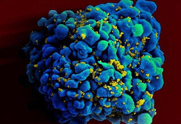 Hình ảnh các hạt HIV tấn công một tế bào của người. Ảnh: Daily Mail