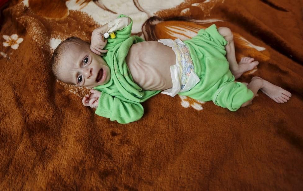 Em bé Ali Mohammed al-Tawaari, mới 6 tháng tuổi, trong một bệnh viện tại Sanaa, Yemen hôm 28/7. Ra đời ngay trước khi nổ ra cuộc chiến thảm khốc tại Yemen, cậu bé thiếu sự chăm sóc y tế trong những tuần đầu mới chào đời, hiện bị suy dinh dưỡng nặng và phải đấu tranh giành sự sống trong bệnh viện bị bom phá hủy nặng nề ở thủ đô Sanaa.