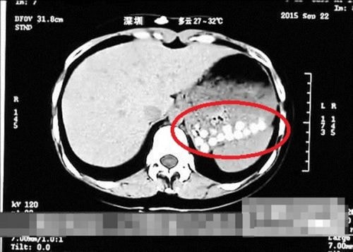 Hình ảnh chụp cắt lớp dạ dày một người sau khi uống trà sữa trân châu. Ảnh: ShandongTV