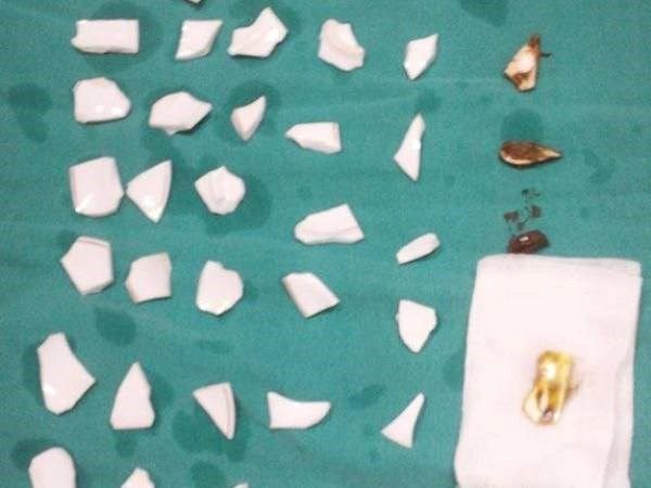 Các mảnh chén vỡ đã được bệnh nhân nuốt. (Ảnh: Bệnh viện Bạch Mai cung cấp)