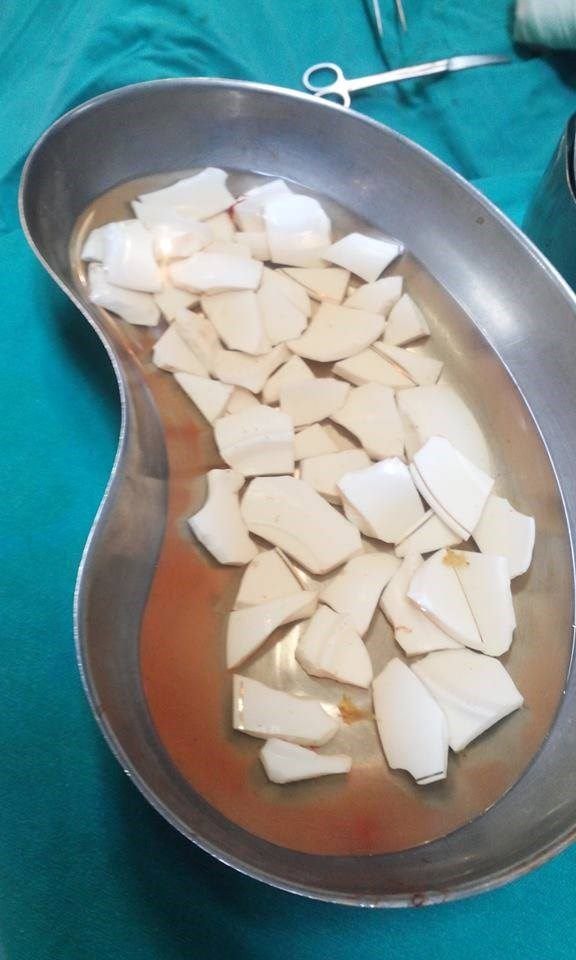 Các bác sỹ đã gắp những mảnh chén này ra khỏi bụng bệnh nhân. (Ảnh: Bệnh viện Bạch Mai cung cấp)