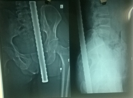 Hình ảnh X-quang cho thấy rõ, thanh sắt đâm xuyên từ thắt lưng xuống tầng sinh môn bệnh nhân.