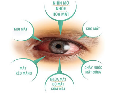  Đau rát, đỏ, chảy nước mắt hoặc các kích ứng là triệu chứng thường gặp nhưng triệu chứng nhìn mờ, giảm thị lực mới là đặc trưng của bệnh mắt nguy hiểm