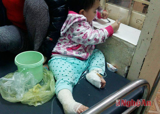 Bé Nguyễn Thị Bảo Trân bị bỏng nặng khu vực chân do bị túi sưởi ấm bục phát nổ, đang được điều trị vế thương tại Bệnh viện Sản-Nhi Nghệ An. 