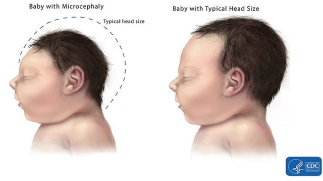 Zika được cho là liên quan tới tật đầu nhỏ ở trẻ sơ sinh