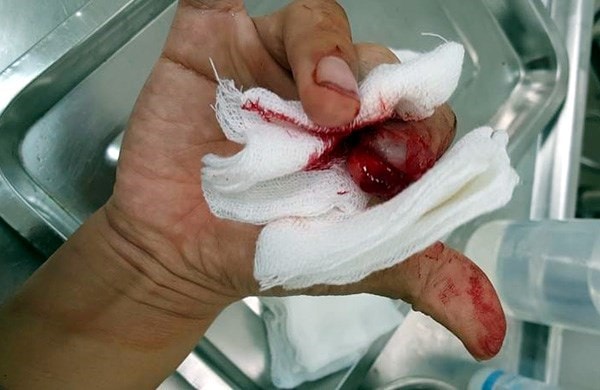 Ngón tay Nhà báo Đỗ Doãn Hoàng bị dập, bong móng tay.