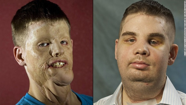 Mitch Hunter trước và sau ca ghép mặt. Ảnh: CNN.