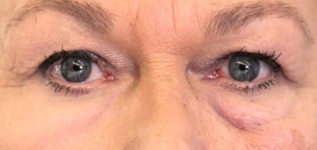 Kết quả ấn tượng khi áp dụng “lớp da phụ” để che bọng mắt: mắt bên trái khi có lớp da phụ phủ lên trên, trông mịn màng và tự nhiên. Ảnh: Olivo Labs. 