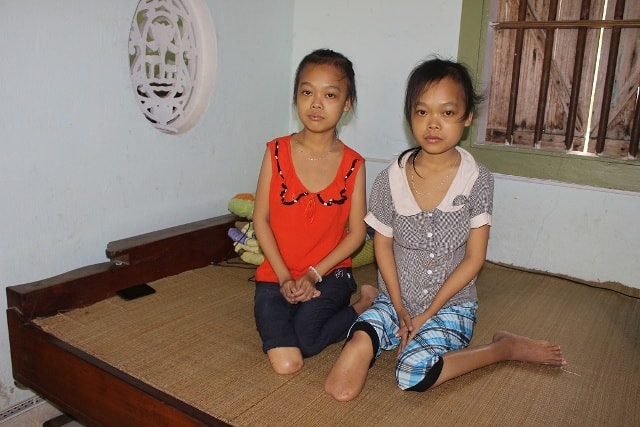 Nhờ sự giúp đỡ của bạn đọc báo Nghệ An, 2 cháu Hiền Hòa đã được phẫu thuật.