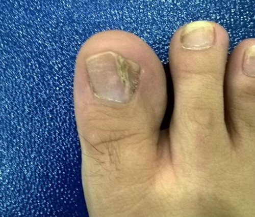 U cuộn mạch dưới móng khá thường gặp, có thể xảy ra ở cả ngón tay lẫn ngón chân. Ảnh: X.A