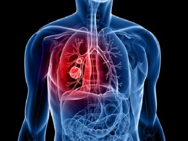Bệnh Enterovirus D68: Enterovirus D68 là một bệnh nhiễm virus lây lan qua các chất dịch cơ thể, ảnh hưởng nặng đến hệ thống hô hấp của nạn nhân, gây tử vong trong vòng vài giờ sau khi bị nhiễm.