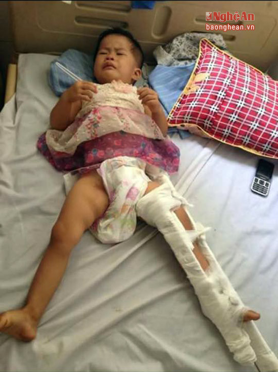 Cháu Lương Thị Nga (2 tuổi) đang điều trị tại khoa Chấn thương tại bệnh viện.