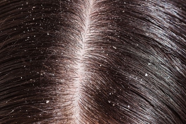Điều trị gàu: Để thoát khỏi gàu, bạn có thể nghiền nát 2 viên aspirin trộn với một lượng dầu gội đầu vừa đủ, sau đó gội đầu như bình thường.