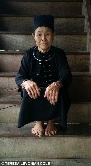 Cụ bà 80 tuổi với đôi bàn chân xương xẩu. Ảnh: Teresa Levonian Cole.