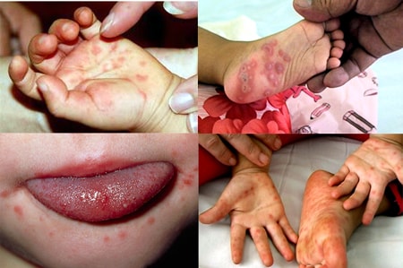 Bệnh tay - chân - miệng là bệnh do virus gây ra chủ yếu ở trẻ dưới 10 tuổi và có thể xảy ra đối với người lớn.  Ảnh: Songkhoe.vn