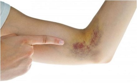 Những biểu hiện bị ung thư máu mà bạn cần biết ảnh 8