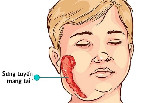 Biểu hiện thường gặp của bệnh quai bị là sưng tuyến mang tai. Ảnh: cdc.