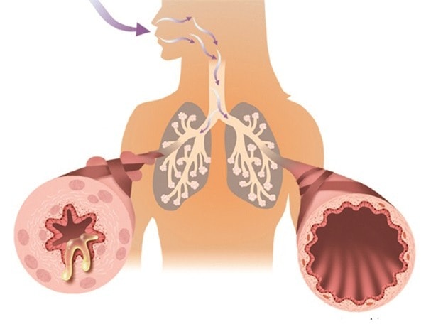 Phế quản của trẻ bị viêm, xuất tiết.