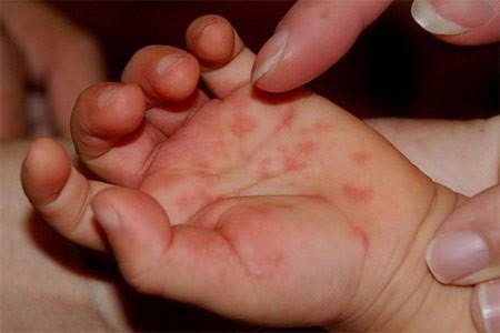 Cả nước đã ghi nhận gần 2.100 trường hợp mắc bệnh tay chân miệng.  (ảnh: KT)