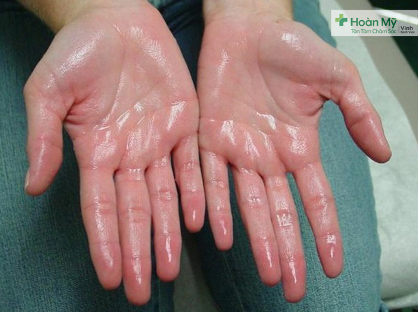 Bàn tay người bệnh bị tăng tiết mồ hôi.