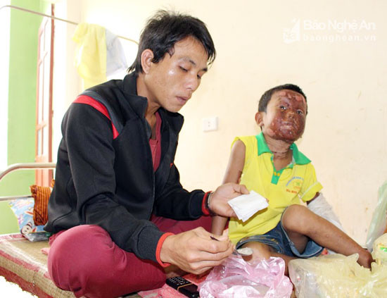 Anh Lô Văn Tám chăm sóc bé Xuyên đang điều trị tại bệnh viện. Ảnh:Đình Tuân.