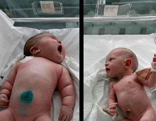 Bé Khalina (trái) so với em bé có trọng lượng bình thường.  Ngày 26.9. 2007, em bé Nadia Khalina  ở Siberia đã chào đời với trọng lượng đáng kinh ngạc 7,75kg. Mẹ của em bé cho biết khi mang thai hầu như cô chỉ ăn khoai tây và đã bị tiểu đường thai kỳ. 