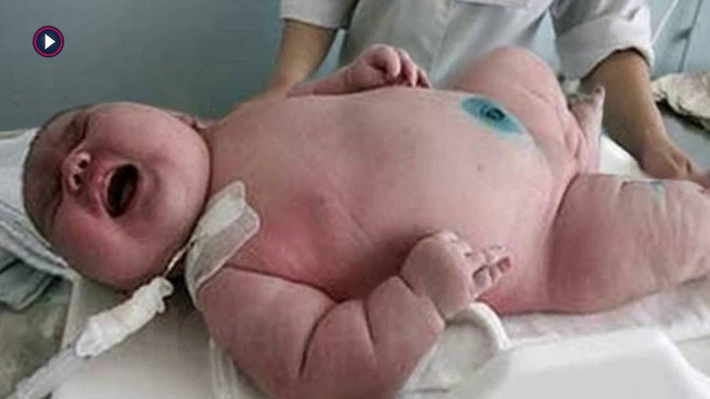 Ngày 4/6/2015, một sản phụ người Australia đã sinh một đứa bé khổng lồ nặng tới 18 kg tại bệnh viện King Edward Memorial ở Ấn Độ. Trọng lượng của em bé khiến các bác sĩ và y tá bệnh viện phải 