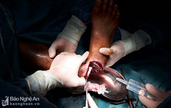 Ca phẫu thuật nối lại cẳng chân bị đứt lìa cho bệnh nhân Vi Văn Nghiên kéo dài 4 tiếng đồng hồ. Ảnh: Thu Hiền