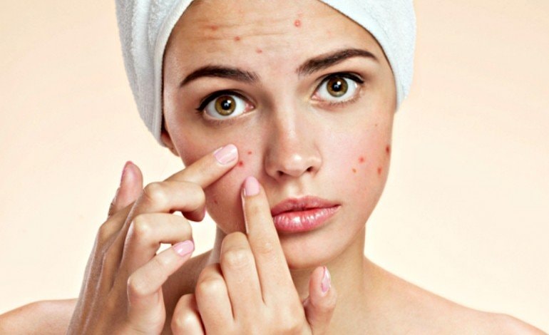 Mụn trứng cá sẽ không còn là lỗi phiền lòng của hàng triệu người khắp thế giới khi có vắc xin ngừa mụn ra đời