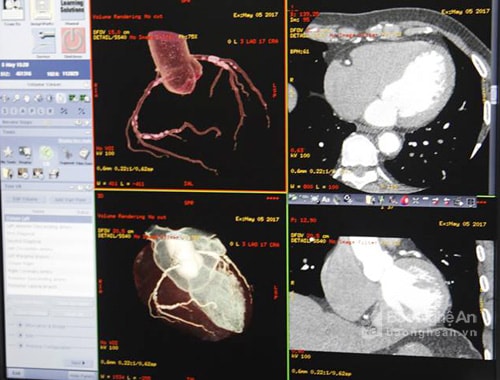 Hình ảnh Động mạch vành Bằng máy chụp CT scanner 128 lát. Ảnh: PV