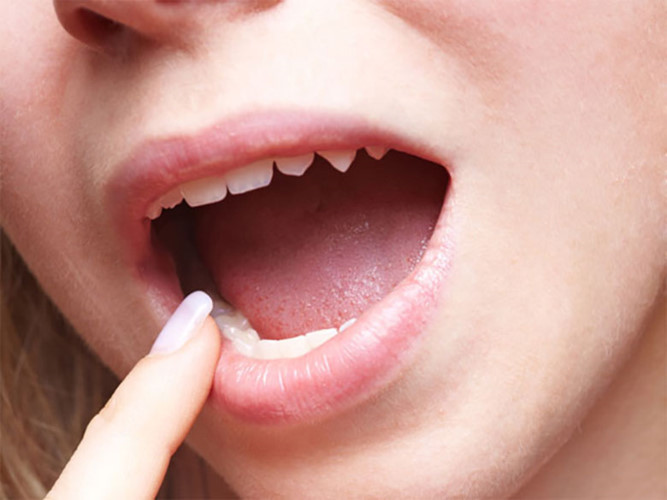 Nhiệt miệng: Một số người có thể bị di ứng với xoài. Các triệu chứng bao gồm ngứa, sưng xung quanh miệng, môi và đầu lưỡi. Thông thường, các triệu chứng có thể xảy ra ở những người nhạy cảm ăn xoài xanh. Tiêu thụ xoài phải được hạn chế ở mức tối thiểu.