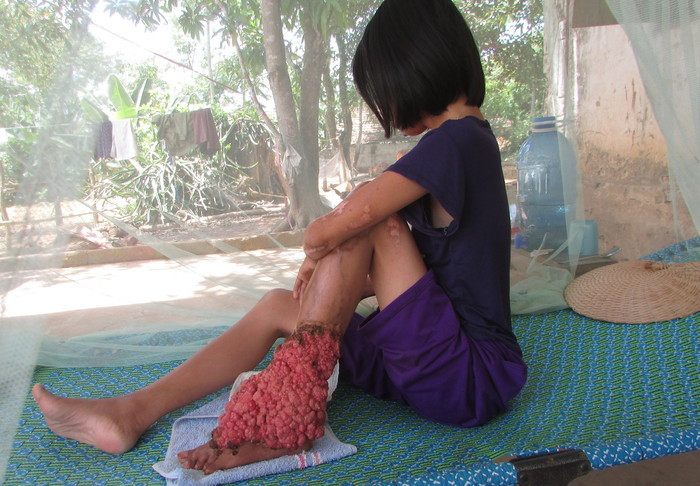 Bệnh tình của cô gái Nguyễn Thị Thanh hiện đang ngày một xấu dần, phần u nhọt đang ăn xuống bàn chân khiến cô không thể di chuyển được. Trên nửa phần cơ thể bên trái của Thanh là dày đặc những vết sẹo không thể lành. Ảnh: Như Sương