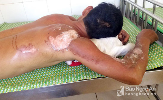 Ông Giản Viết Hùng bị bỏng nặng đang điều trị tại Bệnh viện Đa khoa huyện Đô Lương. Ảnh: CK