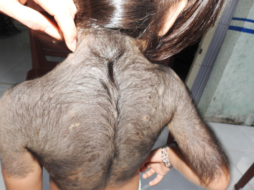 Hơn phân nữa phần lưng bé gái lông đen mọc dày đặc và đang phát triển tiếp. Ảnh: Phúc Hưng.
