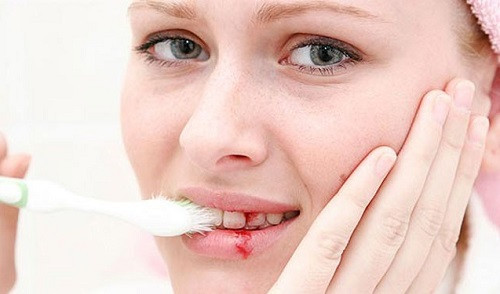 Người bị sốt xuất huyết đánh răng nhẹ nhàng, không chà xát quá mạnh để giảm nguy cơ bị chảy máu chân răng
