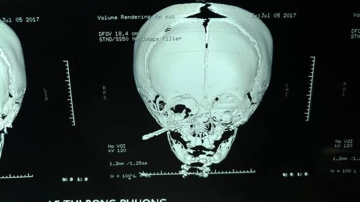 Hình ảnh chụp Ct scanes sọ não cho bé. Ảnh: Thu Hiền