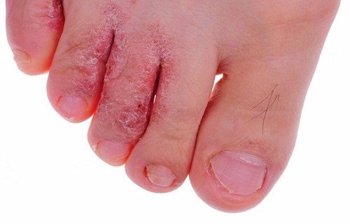 Nếu bạn đang sống trong vùng mưa lũ, hãy lưu cho mình cách trị nước ăn chân tay đơn giản 