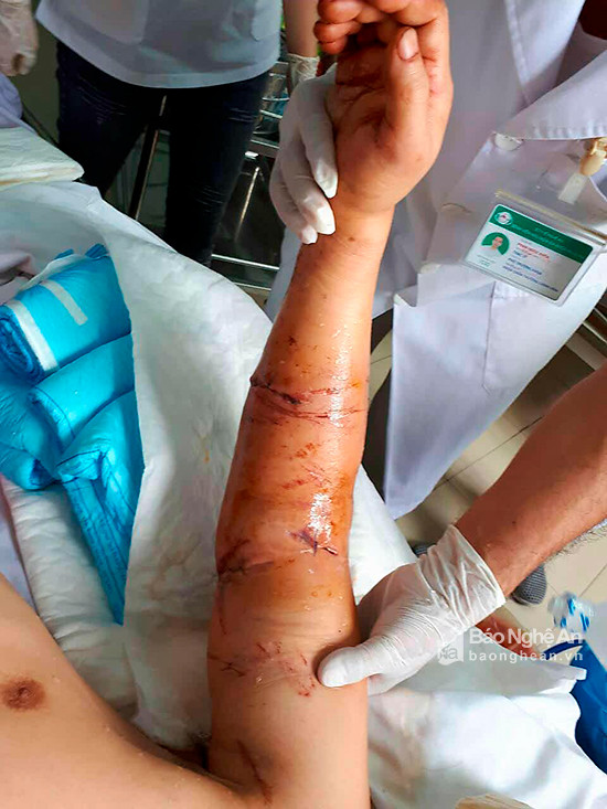 Cánh tay sau khi mổ của bệnh nhân. Ảnh: Hoàng Yến