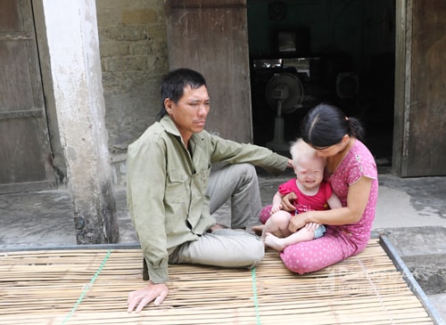 Mắt cháu Kiều Anh khi tiếp xúc với ánh sáng không nhìn thấy gì. Ảnh: Đạm Phương