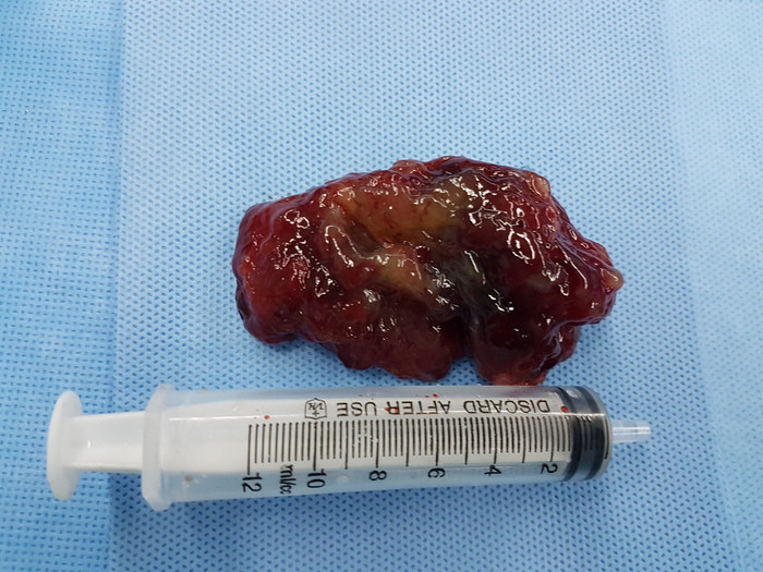 Khối u nhầy kích thước 5x4cm trong buồng tim của bệnh nhân đã được cắt bỏ. Ảnh: Hoàng Yến