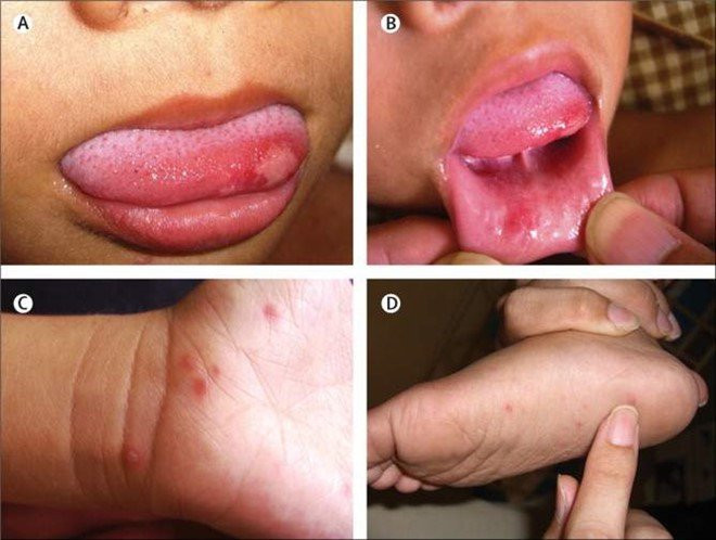 Các biểu hiện của bệnh tay chân miệng ở trẻ. Ảnh: Internet