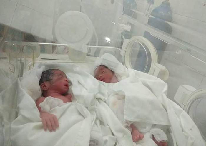 Hai bé song sinh được chuyển xuống Bệnh viện Sản - Nhi Nghệ An để được điều trị tốt hơn. Ảnh: Phương Hảo